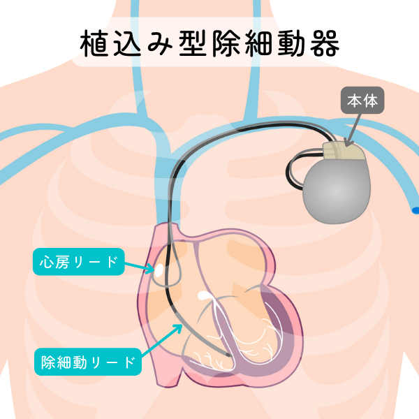 ストア icd リード感染