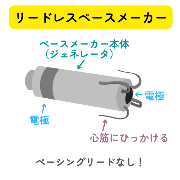 宇野コラム 新型ペースメーカー リードレス トップ ペースメーカー