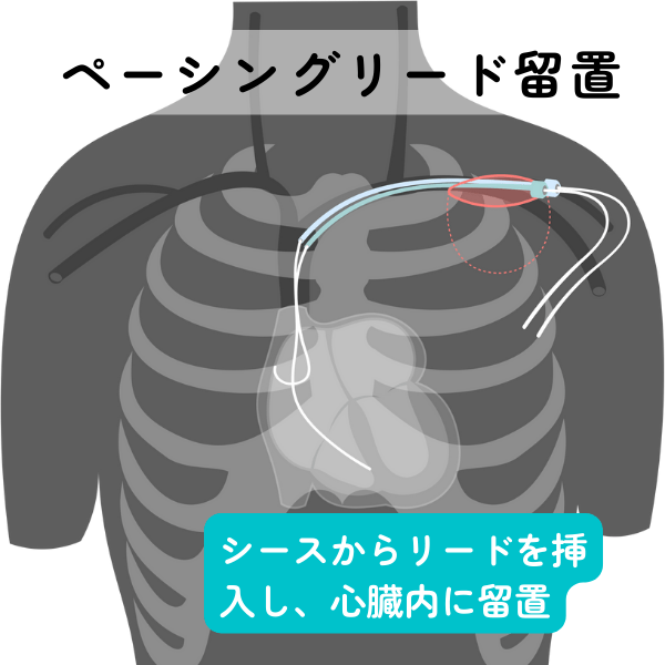 ペースメーカー リード ストア 固定