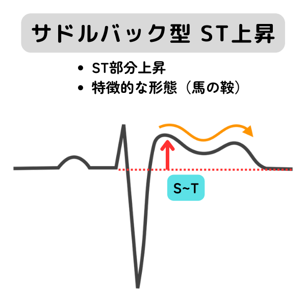 反時計軸回転 非特異的st-t変化 販売 20代