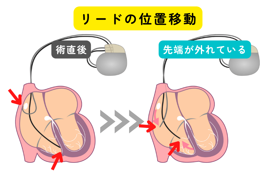 ペースメーカー・両室ペーシング・植込み型除細動器の手術 〜入院から退院まで〜 | 不整脈ドキドキクリニック