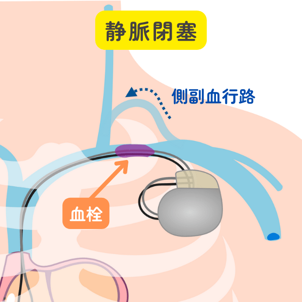 人気 ペースメーカー リード 血栓